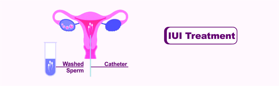 Best IUI Center in Delhi