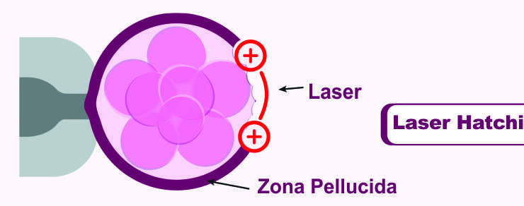 Laser Assisted Hatching
