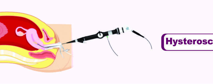 Hysteroscopy