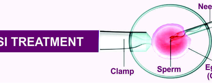 Intracytoplasmic Sperm Injection (ICSI)