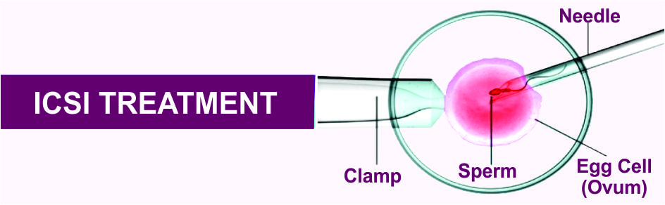 ICSI Fertility Treatment in Delhi
