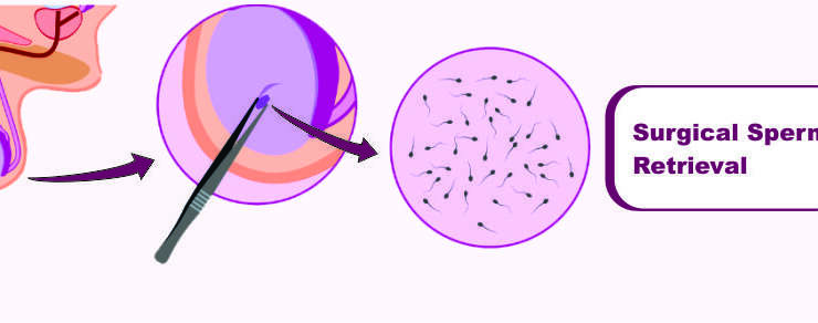 Surgical Sperm Retreival (SSR)