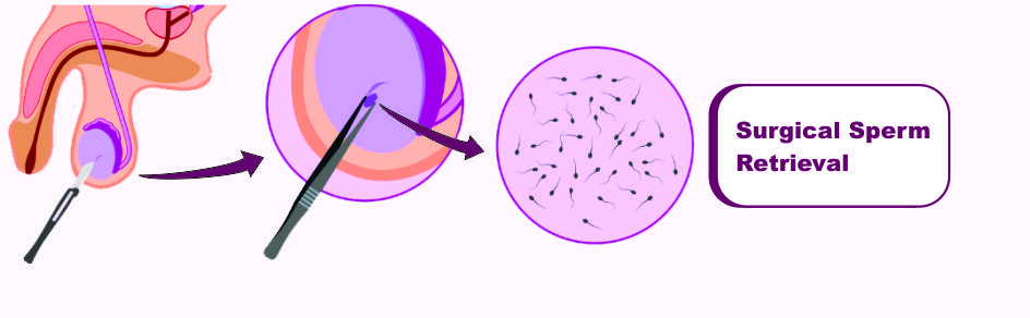 Surgical Sperm Retreival (SSR)